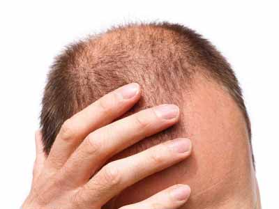 دلایل علمی ریزش مو در آقایان